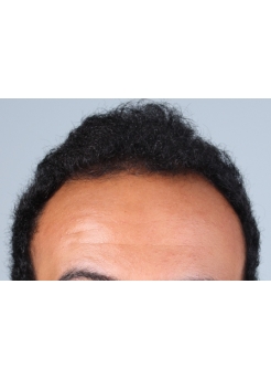 Before Hair Transplant&nbsp;Front